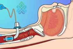 آموزش مراقبت در تراکئوستومی